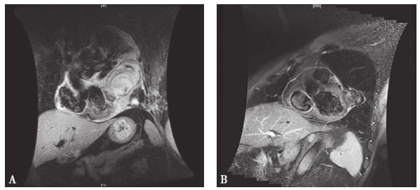 /uploads/image/2025-06-11/145035709图1 心脏磁共振.jpg 图1 心脏磁共振